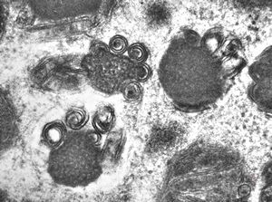 F,23y. | mast cell - granules with scroll-like formations - n. suralis, demyelinating neuropathy F,23y. | mast cell - granules with scroll-like formations - n. suralis, demyelinating neuropathy